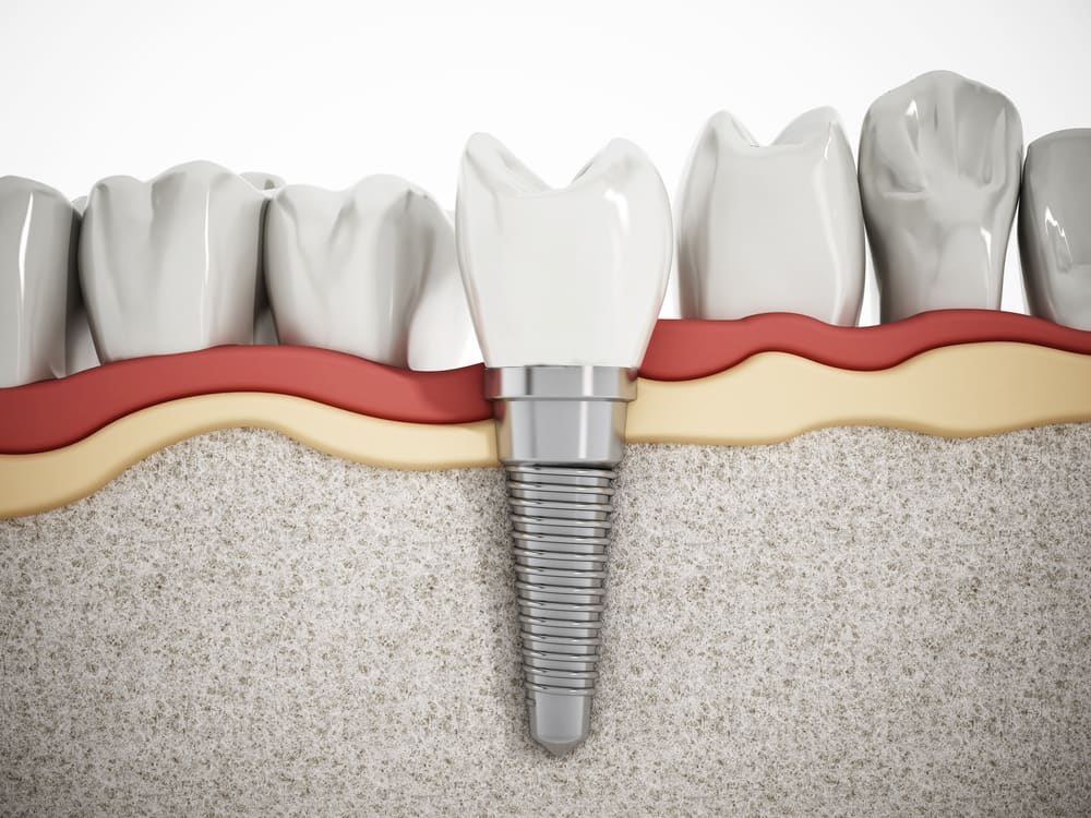 Dental implant diagram